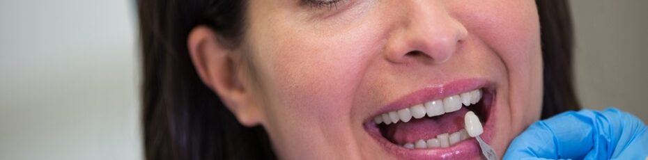 dentist showing porcelain veneers