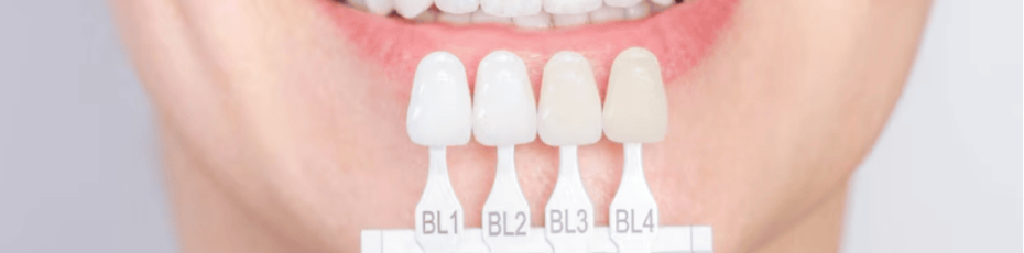 step by step process of getting porcelain veneers