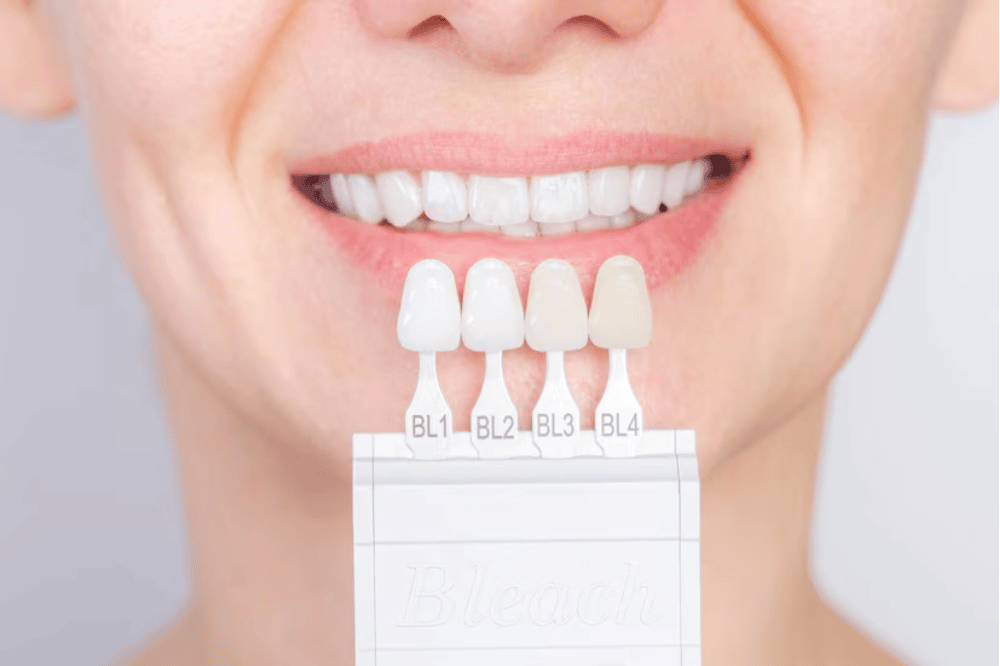 step by step process of getting porcelain veneers